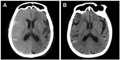 Association between general anesthesia and contrast-induced encephalopathy after endovascular treatment on neurovascular diseases